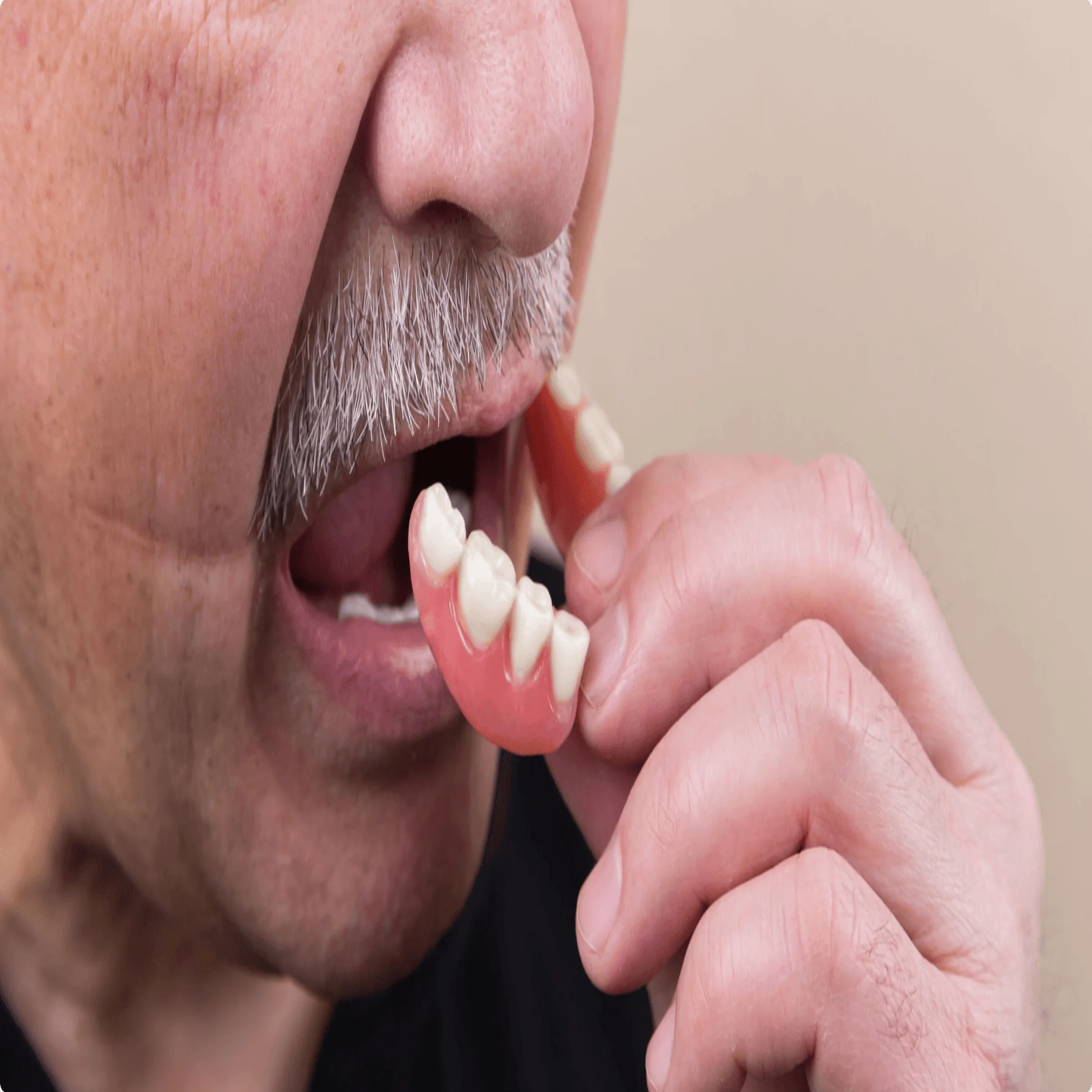 Person inserting partial denture into lower jaw with mouth open.