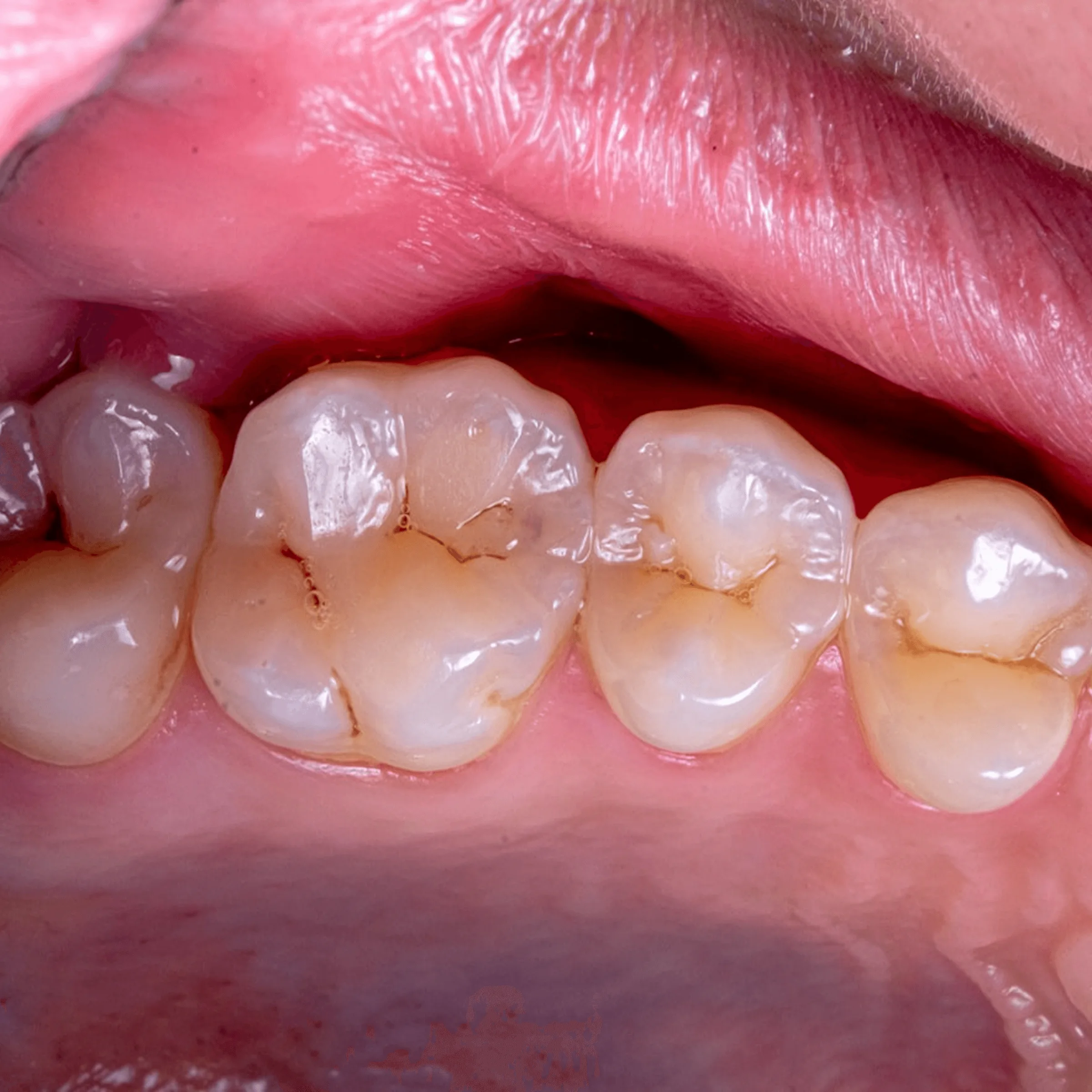 Close-up of healthy lower molars with natural grooves and slight discoloration, gums appear pink